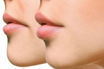 0,5 kubika polutrajnog filera za punjenje usana ili popunjavanje bora, popust