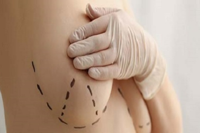 Povećanje grudi, AKCIJA