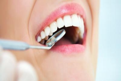 Uklanjanje kamenca, poliranje i peskiranje.Popusti